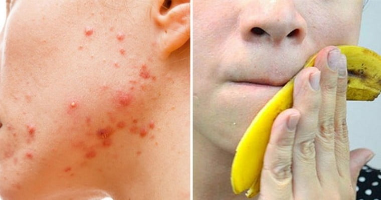 Aprenda O Tratamento Natural Casca De Banana Para Acabar A Acne