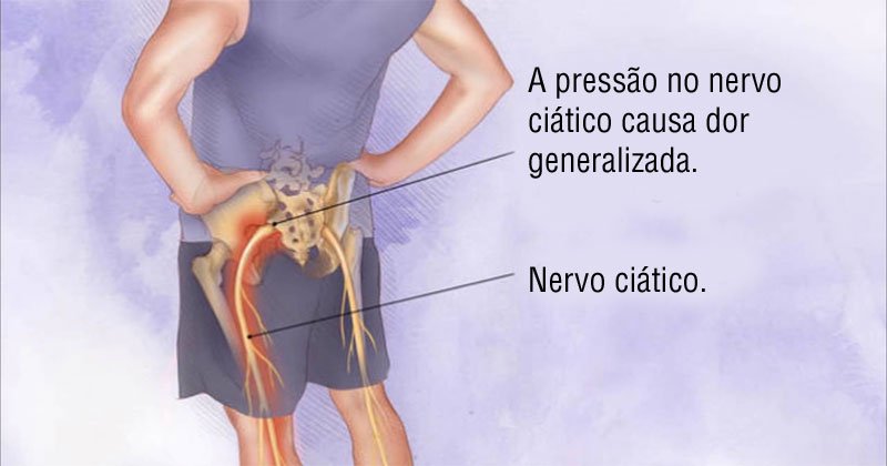 O músculo escondido que causa a dor ciática e alongamentos para alívio imediato